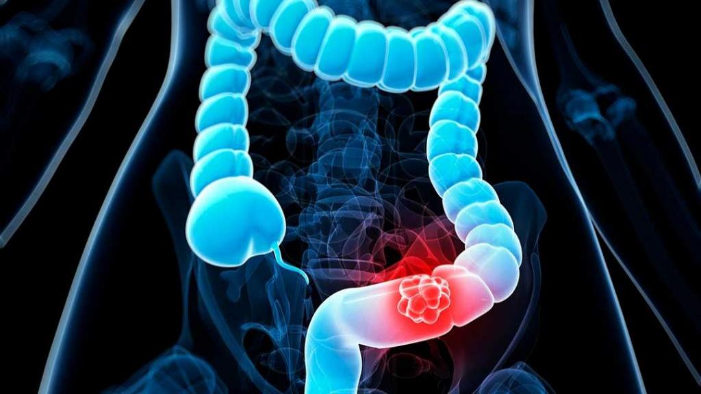 Future Prospects and Market Dynamics of the Colorectal Cancer Screening Market