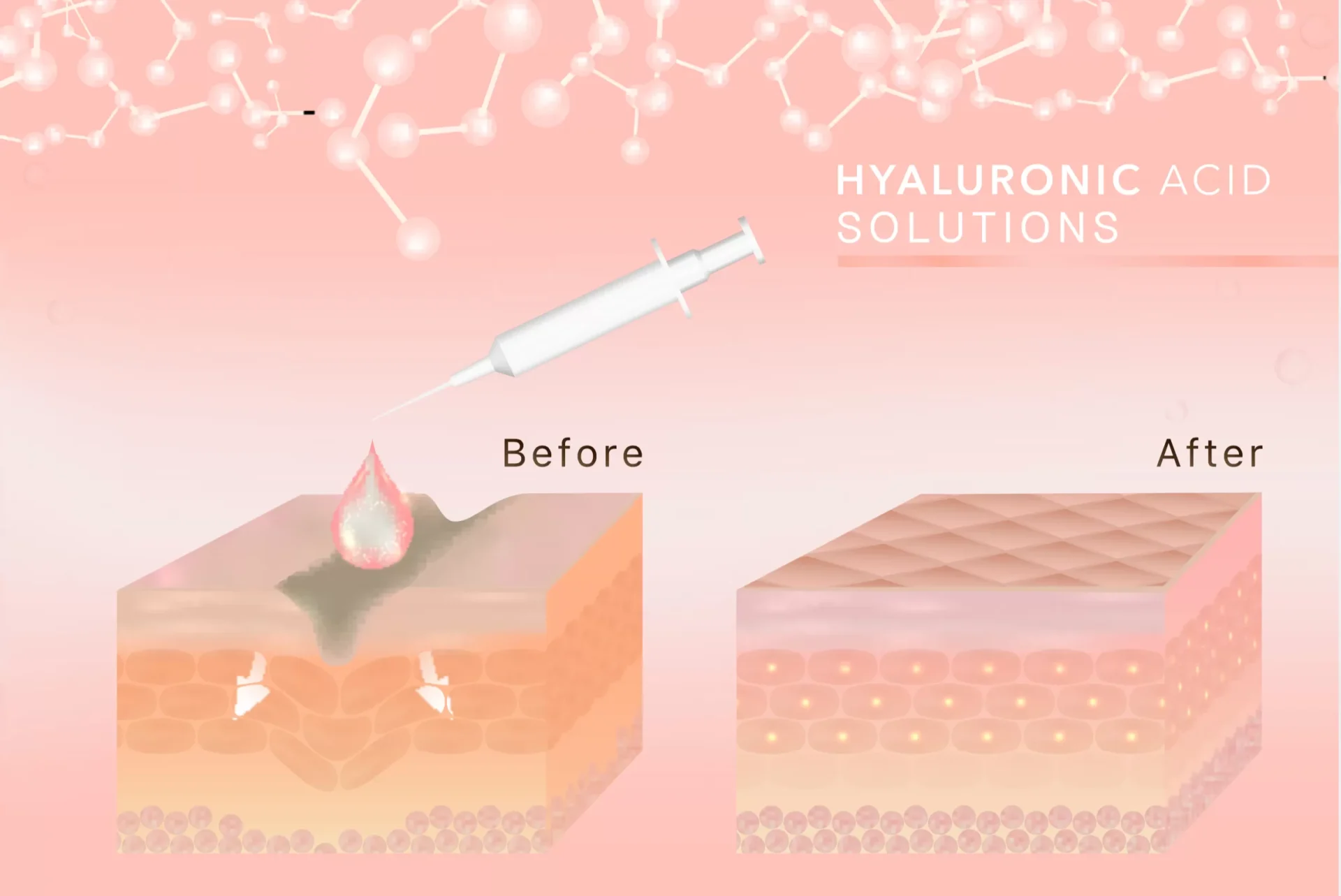 Hyaluronic Acid Products Market Is Estimated To Witness High Growth Owing To Increasing Demand for Dermal Fillers and Rising Geriatric Population