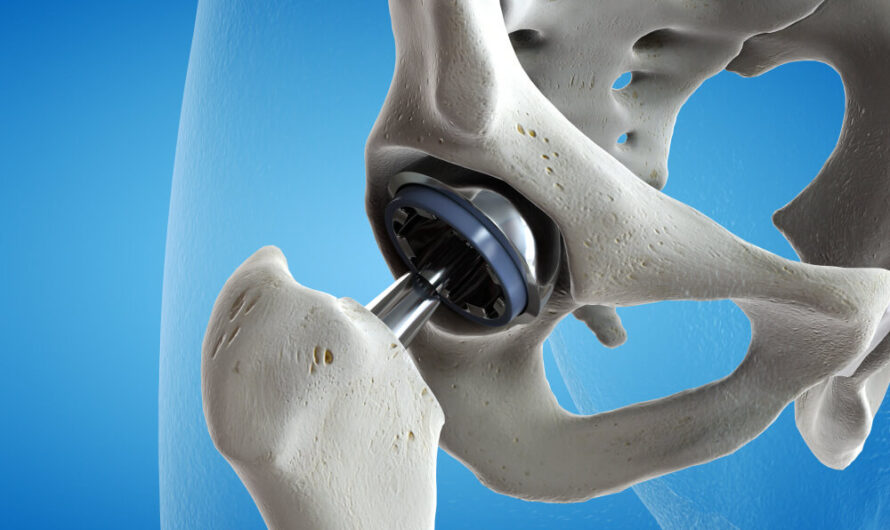 Hip Replacement Market Is Estimated To Witness High Growth Owing To Increasing Prevalence of Osteoarthritis & Rising Geriatric Population