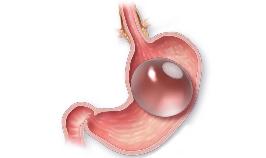 The Intragastric Balloon Market Is Estimated To Witness High Growth Owing to Increasing Prevalence of Obesity