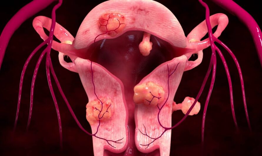 The Rising Adoption of Minimally Invasive Procedures is anticipated to openup the new avanue for U.S. Uterine Fibroid Treatment Market