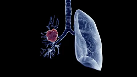 New Study Unveils Key Protein Involved in Lung Cancer Progression and Potential Treatment Strategy