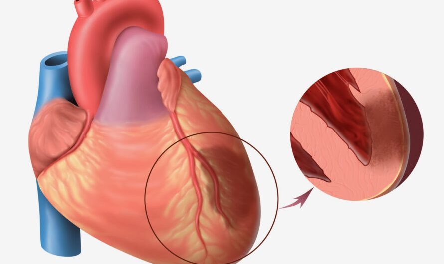 The Global Myocardial Infarction Market Is Driven By Rising Cardiovascular Diseases