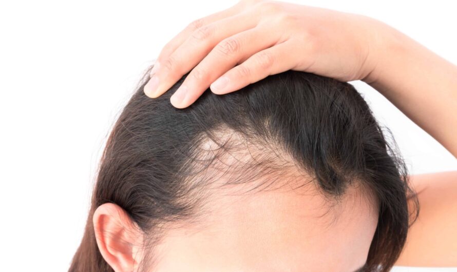 The Global Alopecia Treatment Market Driven by Rising Prevalence of Alopecia Disorders