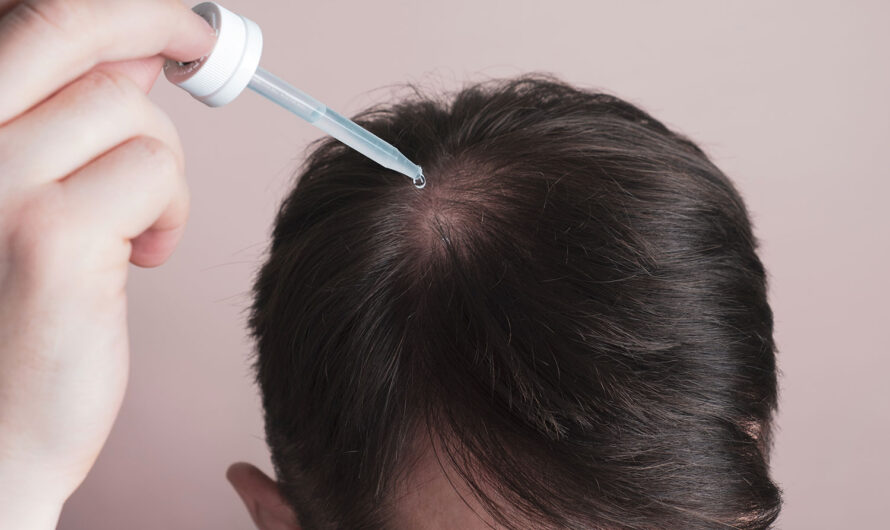 The Global Minoxidil Market is projected to Propelled by Increased Consumer Spending on Hair-Loss Treatment
