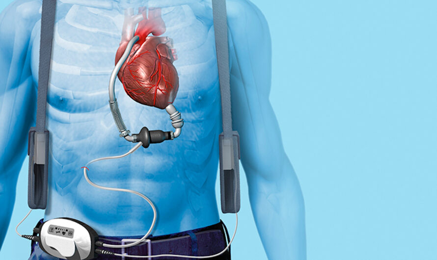 Cardiac Assist Devices Market is expected to be Flourished by Emerging Demand for Minimally Invasive Procedures