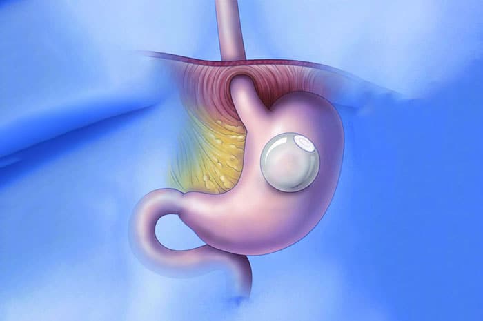The Growing Obesity Epidemic is Driving Demand for the Intragastric Balloon Market