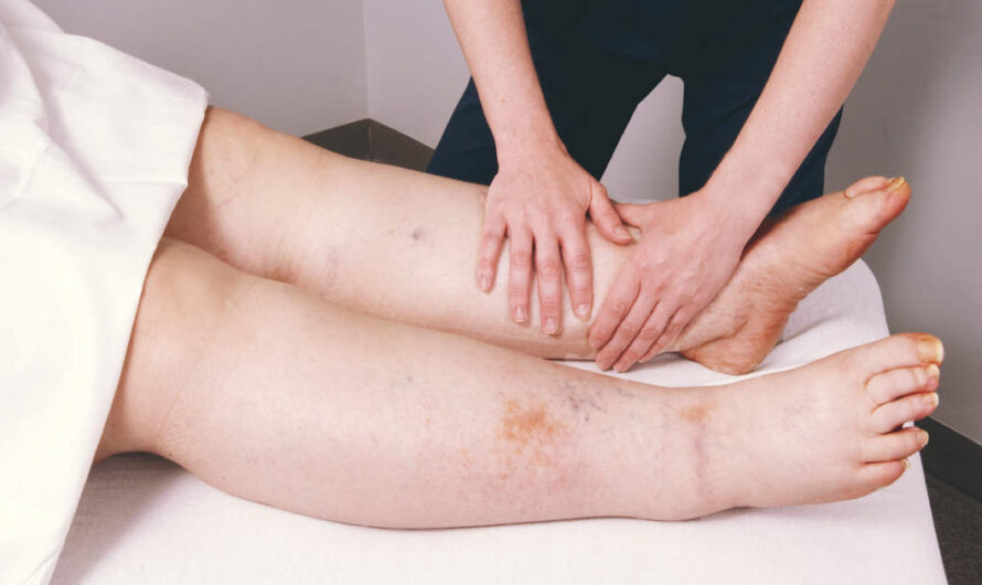The Global Lymphedema Treatment Market is driven by rise in Lymphedema Cases