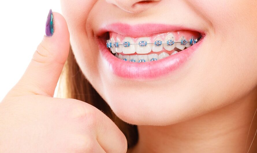 Global Orthodontic Brackets Market is Estimated to Witness High Growth Owing to Rising Orthodontic Treatment Demand