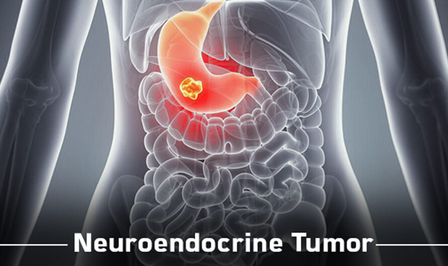 Neuroendocrine Tumor Treatment: Understanding the Options