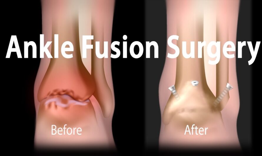The Global Ankle Fusion Nail Market Is Trending Due To Rising Popularity Of Minimally Invasive Surgeries