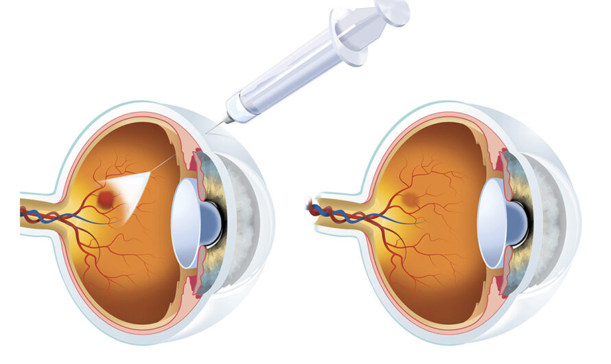 The Global EYLEA Drug Market is primed for growth with expanded indications by 2024