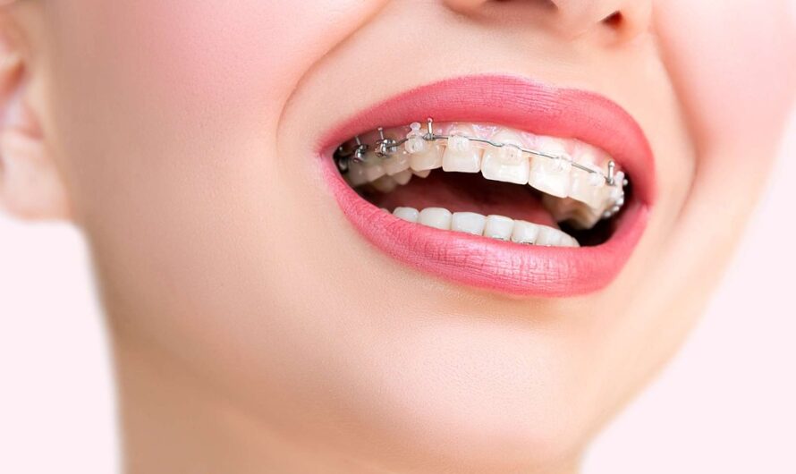 Orthodontic Brackets Industry: Global Orthodontic Brackets Market to Witness Robust Growth by 2027