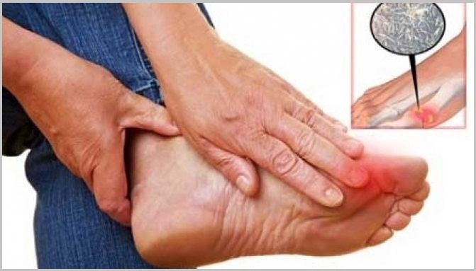 From Diagnosis to Recovery: A Detailed Look at Gout Disease Treatment and Prevention