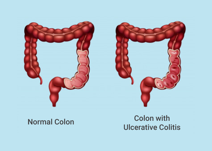 The United Kingdom Ulcerative Colitis Market is trending by growing biologics adoption
