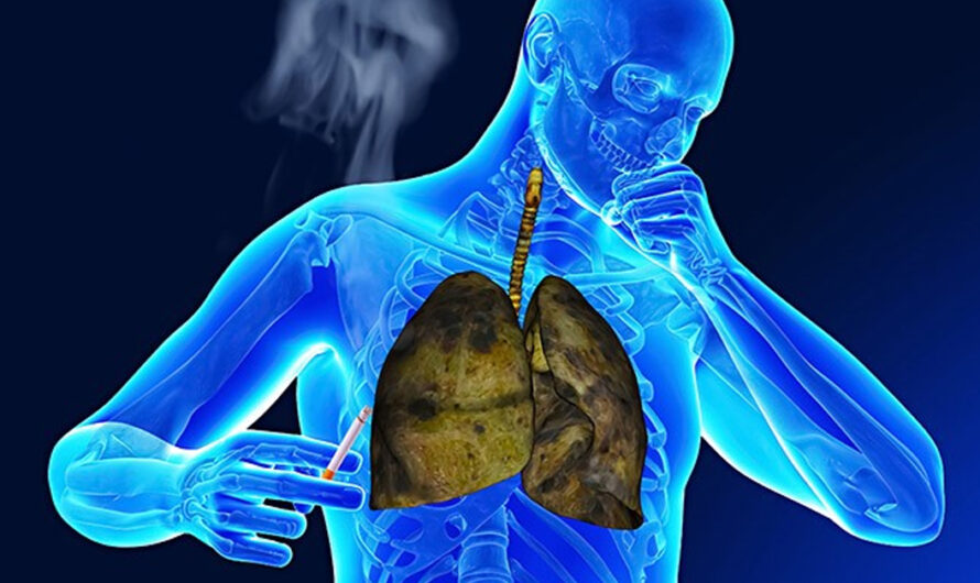Chronic Obstructive Pulmonary Disease Treatment: An Overview