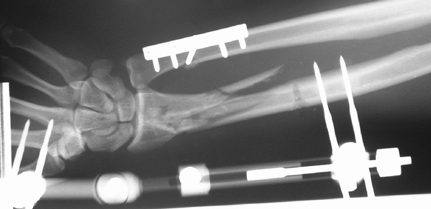 External Fixators: A Valuable Tool for Treating Complex Bone Fractures