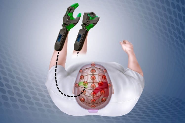 The Rise of Neuroprosthetics : The Emergence of a New Treatment Frontier