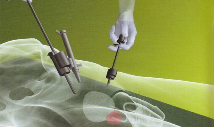 Laparoscopic Electrodes Industry: Global Advancements in Laparoscopic Electrodes Streamline Minimally Invasive Surgeries