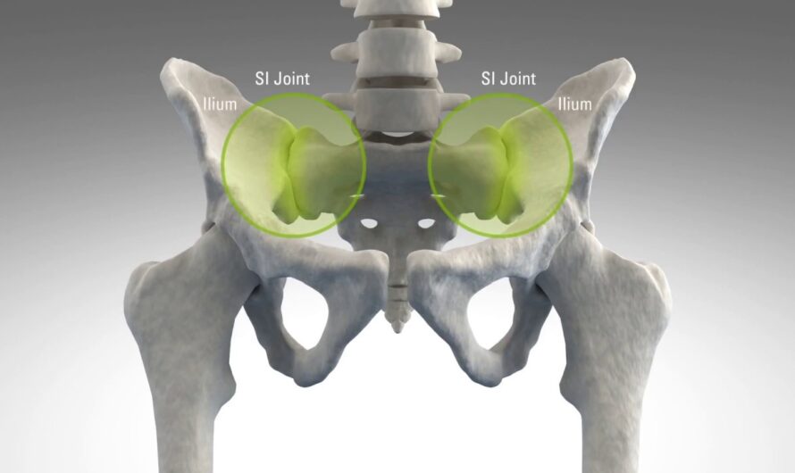Sacroiliac Joint Fusion : Exploring the World of Sacroiliac Joint Fusion A Solution for Chronic Low Back Pain